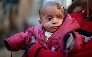 Bebê perde olho em bombardeio na Síria e foto vira símbolo de campanha