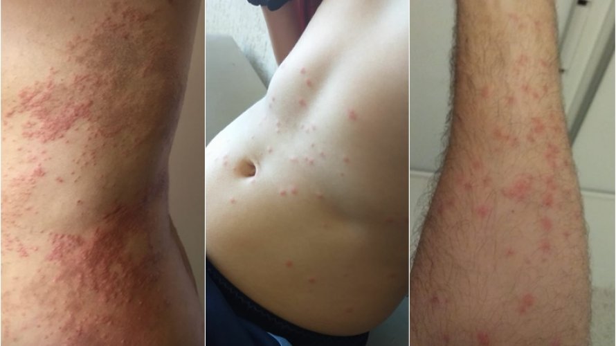Casos de dermatite assustam moradores de condomínios de luxo em Salvador